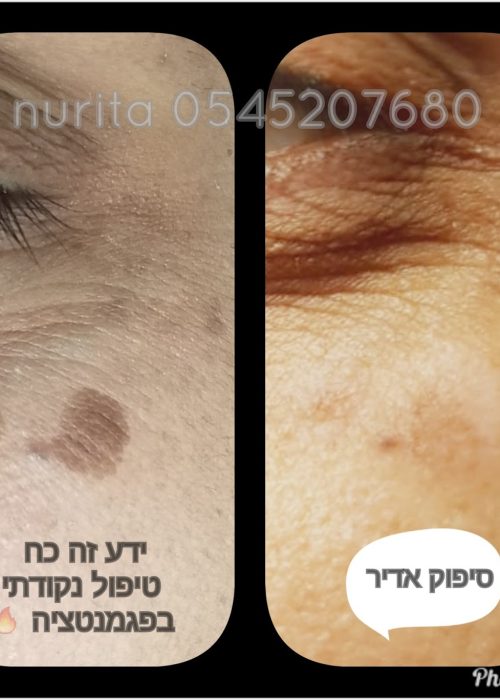 פיגמנט מקומי שטופל ע"י IPL